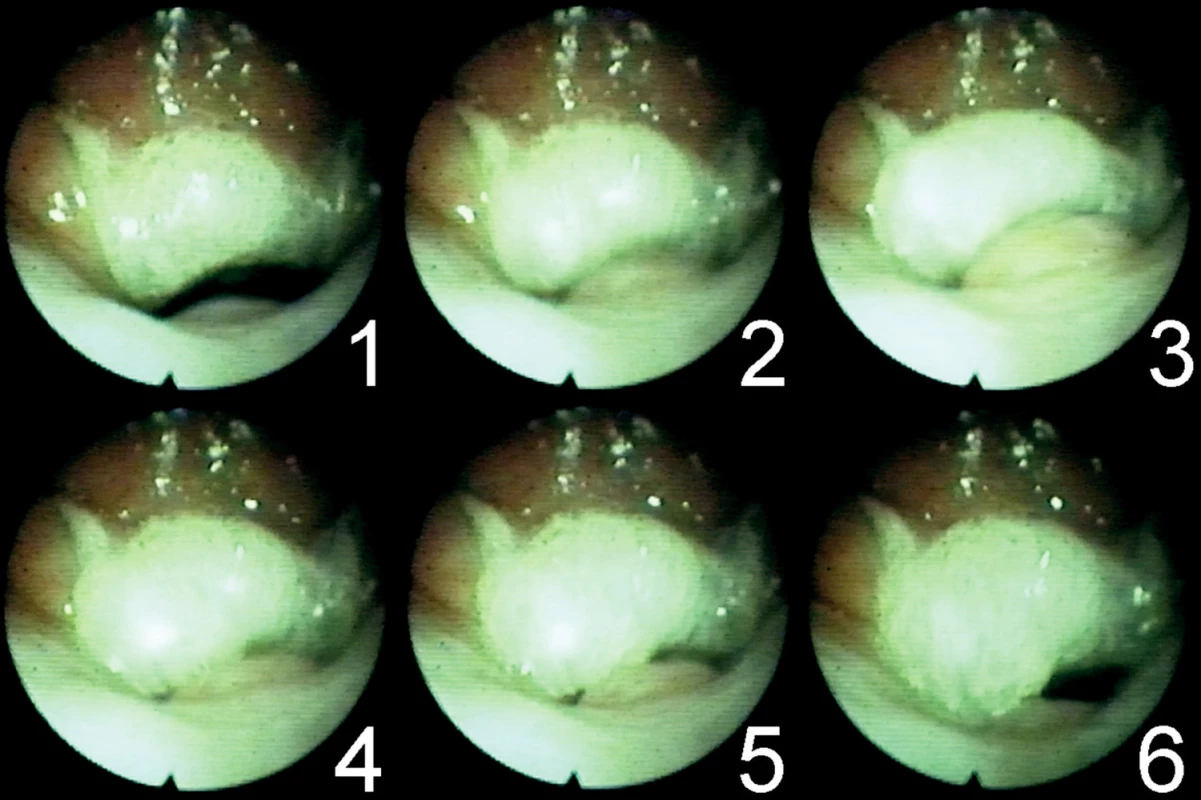 Série snímků zachycující mechanismus velofaryngeálního uzávěru.