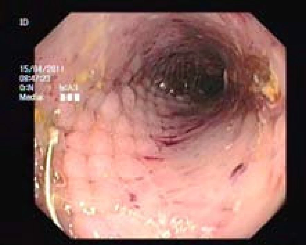 Endoskopický obraz rozvinutého stentu.
Fig. 2. Endoscopic image of developed stent.