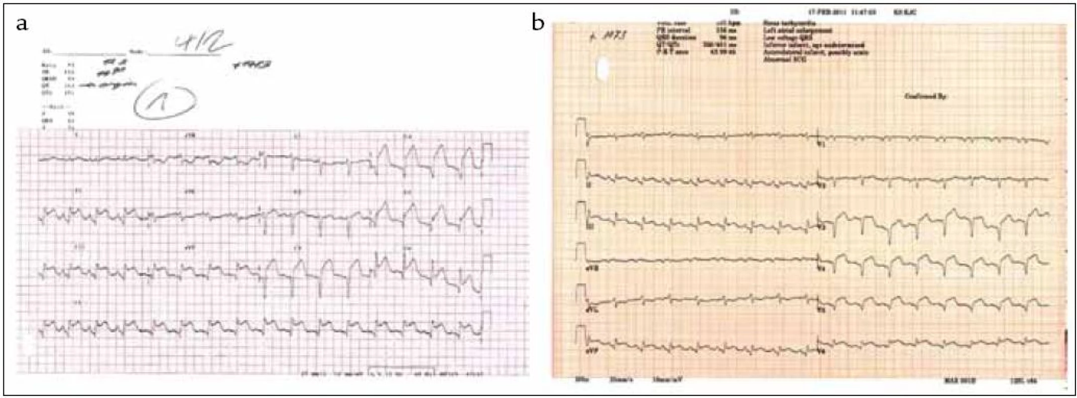 EKG se známkami akutního infarktu myokardu s QS a elevacemi ST úseku ve II, III, aVF, V&lt;sub&gt;2&lt;/sub&gt;–V&lt;sub&gt;6&lt;/sub&gt; při přijetí pacientky k hospitalizaci (a) s mírnou regresí nálezu při propuštění z nemocnice (b).