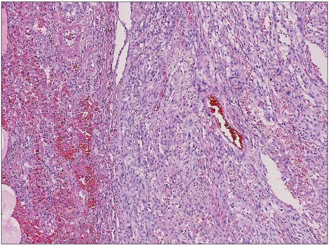 Struktura prokrvácené plicní tkáně s ložiskem nádoru epiteloidního vzhledu Nádorové elementy jsou negativní v průkazu pancytokeratinů, TTF1 a PR. Silná je exprese vimentinu a fokálně EMA, proliferační aktivita KI67 je 25 %. Morfologie i imunohistochemie odpovídají obrazu metastázy anaplastického meningeomu.
Barvení hematoxylin eozinem.