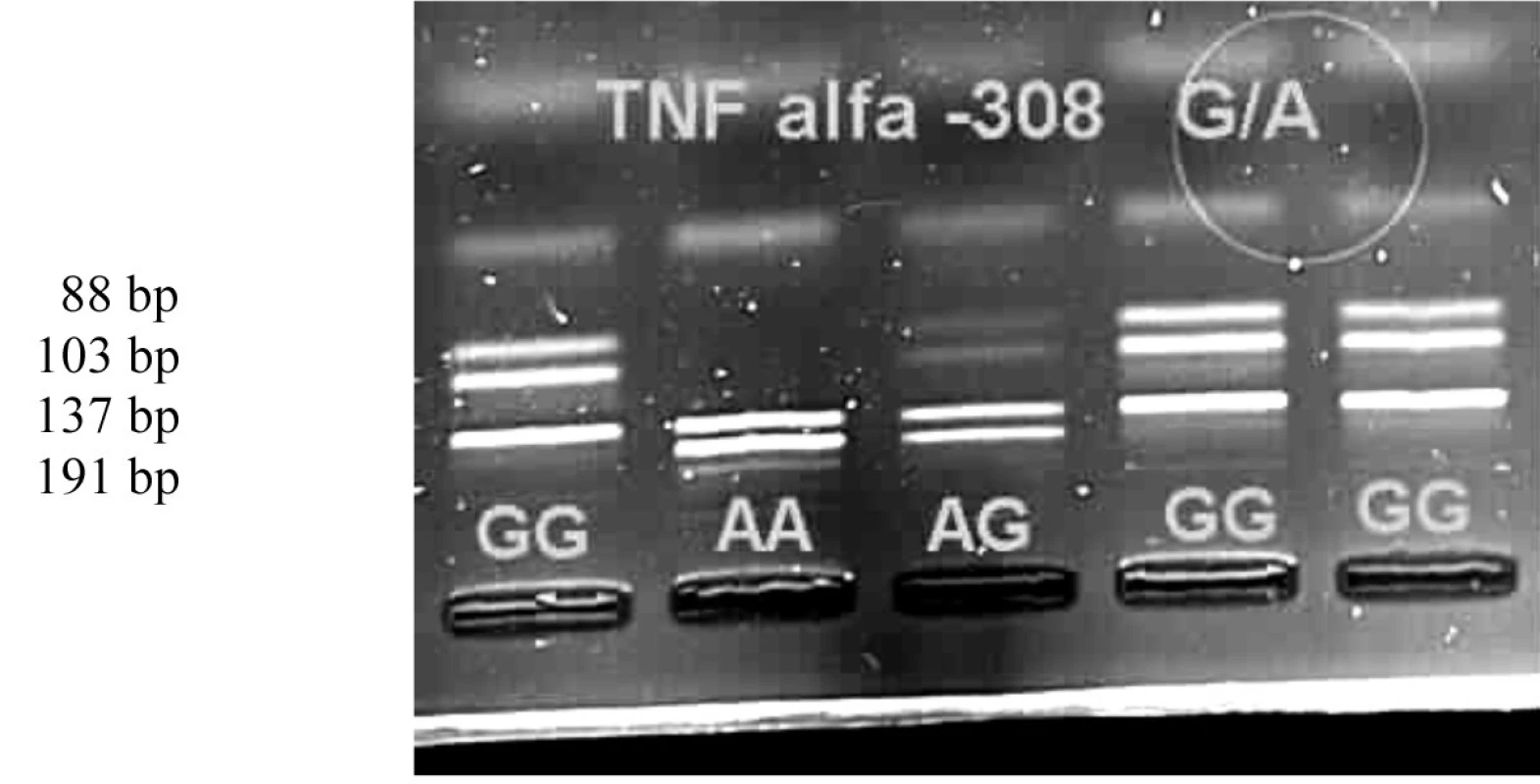 Genotypy polymorfismu -308 G/A na elektroforetickém gelu v UV světle.