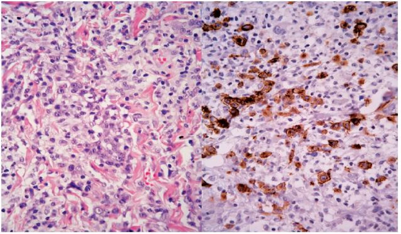 Mezi malými lymfocyty – vlevo lymfoidní elementy se středně velkým jádrem, s prominujícím jadérkem
V centru obrázku je i jedna zachycená mitóza tohoto elementu (HE, původní zvětšení 400krát). Vpravo – lymfoidní elementy střední velikosti jsou CD30 pozitivní (IHC, původní zvětšení 400krát).