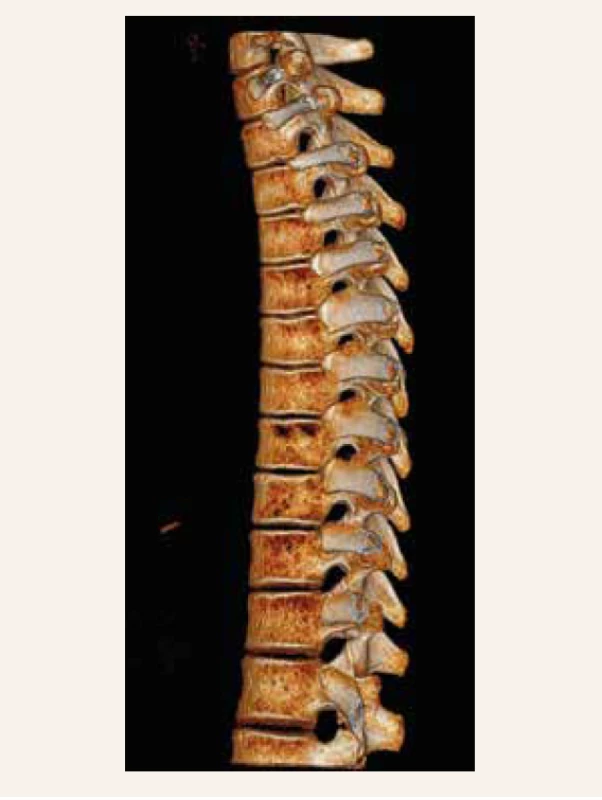 CT-vyšetrenie chrbtice (kazuistika 1)