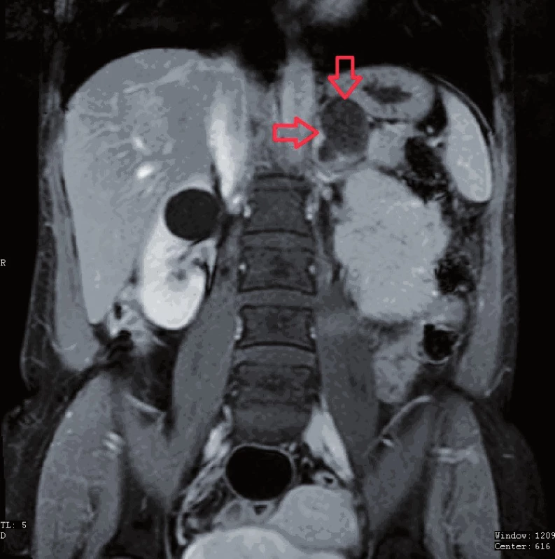 MR – T1 vážený obraz
Fig. 1. MRI – T1 weighted image