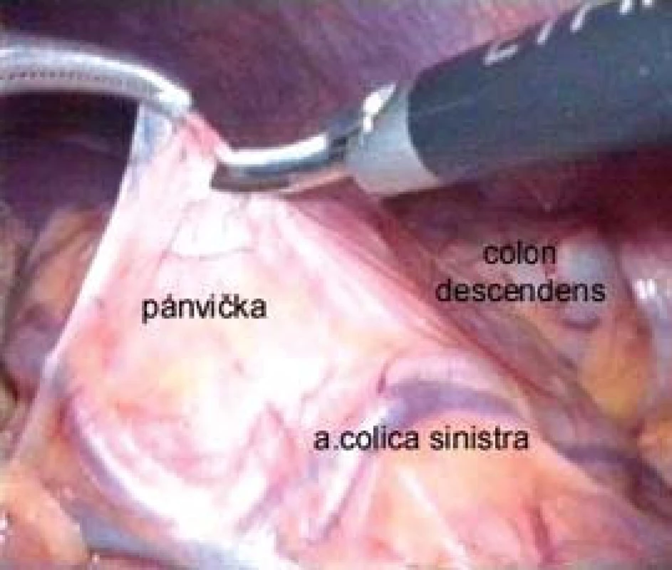 Incize nástěnného peritonea nad vyklenutou pánvičkou mezi kolickými cévami při levostranné transmezokolické pyeloplastice.