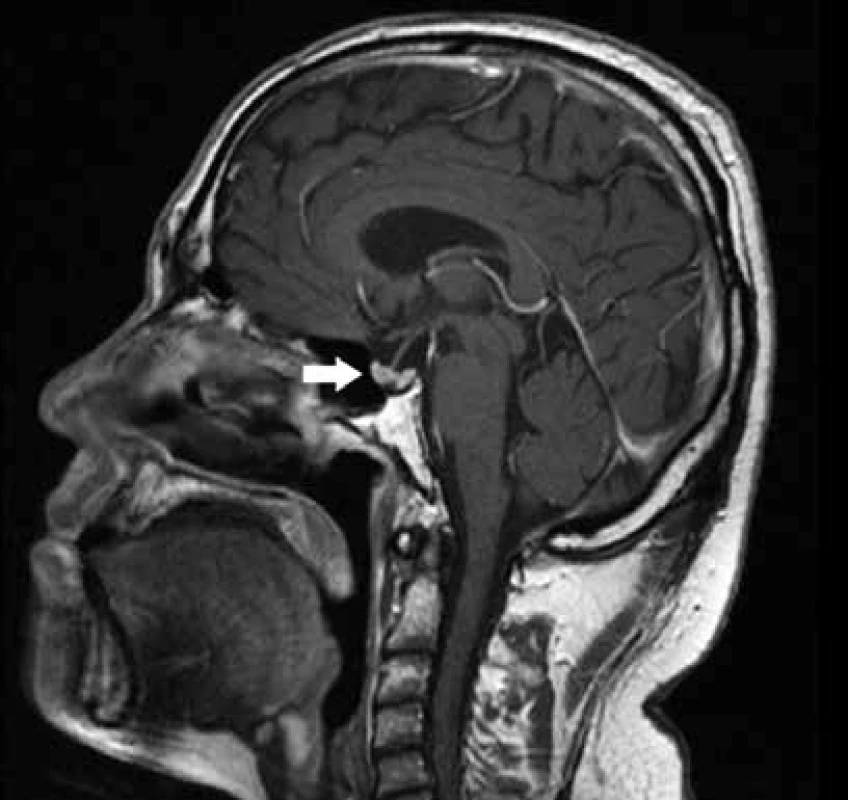 MRI mozku a hypofýzy po ukončení indukční fáze léčby