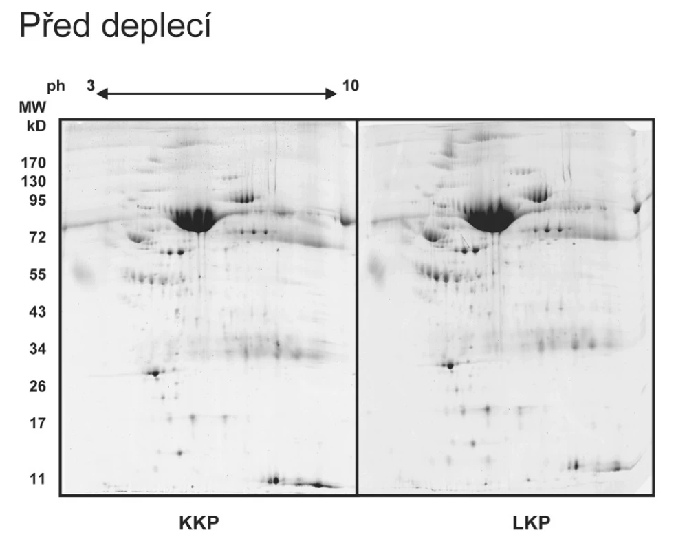 Reprezentativní 2-DE gel KKP a LKP (KKP a LKP vznikly smícháním 5 individuálních vzorků) před deplecí abundantních proteinů. Na gelu jsme identifikovali 264 skvrn (průměrný počet skvrn vyhodnocený na Master gelu). Dominantní skvrna představuje největší plazmatický protein albumin. Gel barvený Sypro-ruby.
