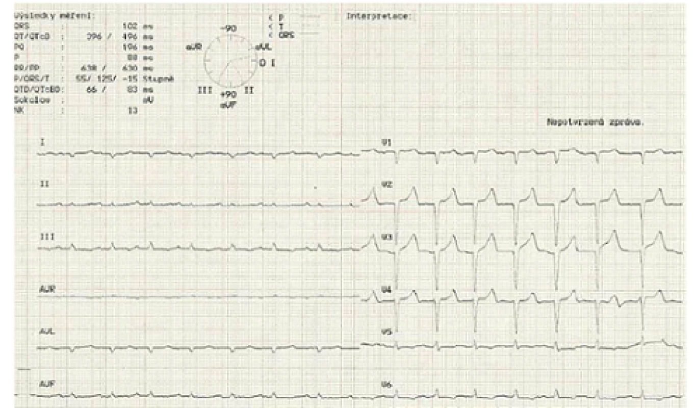 Elektrokardiogram ukazující nízkou voltáž QRS komplexů v končetinových svodech.