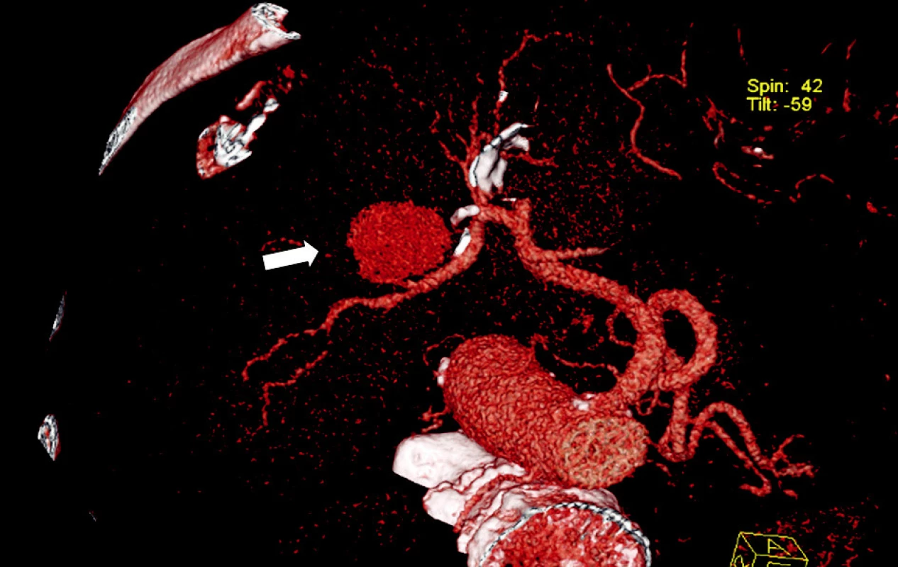 CT angiografie, 2. rekonstrukce - pseudovýduť arteria hepatica dextra (šipka)
Fig. 2. CT angiography, 2nd reconstruction – a pseudo-    aneurysm of the right hepatic artery (arrow)