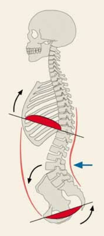 Anteverzní postavení pánve.
Fig. 4. Anteversion of the pelvis.