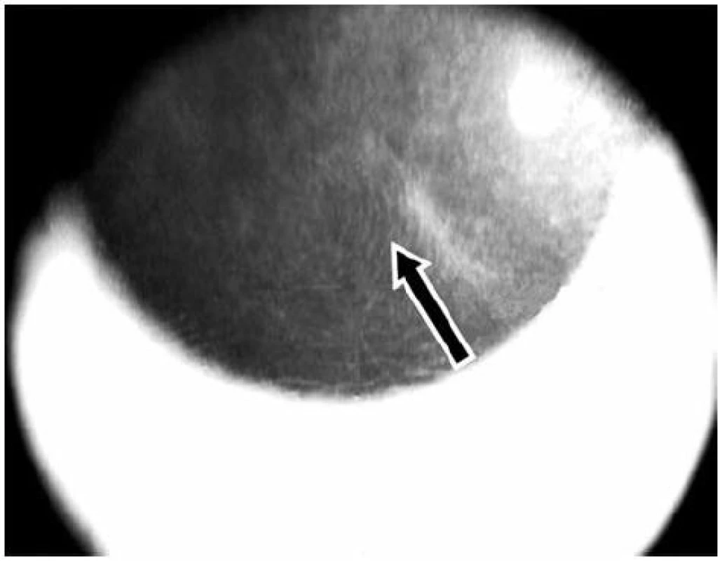 OCT snímek rohovky levého oka – šipka ukazuje záhyby bazální membrány epitelu rohovky