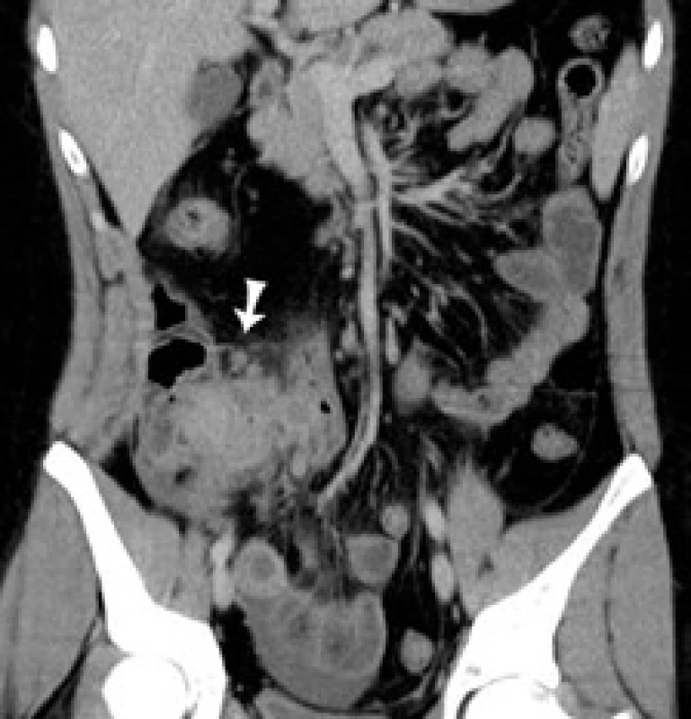 CT koronárny rez: šípka označuje pseudotumor v ileocekálnej oblasti.
Fig. 1. CT of coronary cross-section: arrow indicates pseudotumour in the ileocaecal area.