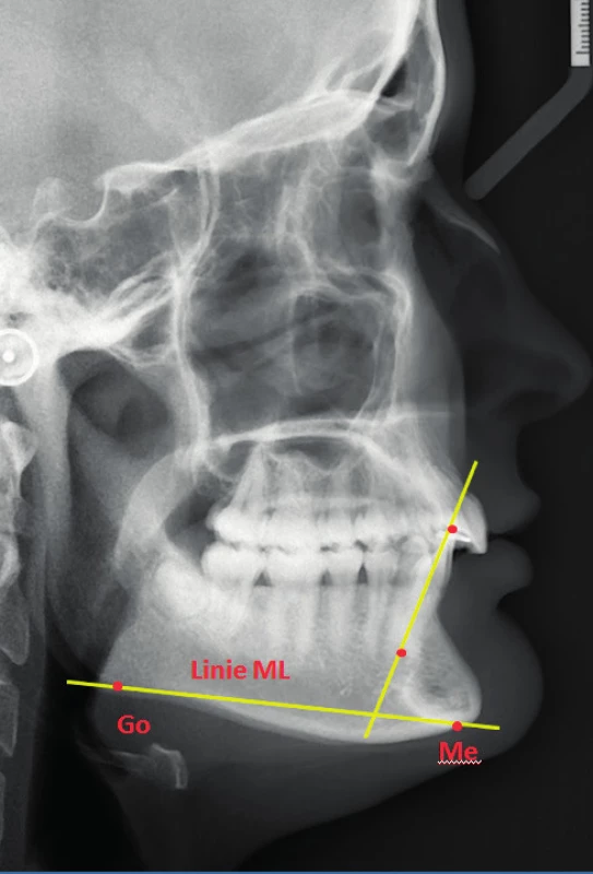 Sklon dolního řezáku (podélné osy) vzhledem k linii ML (archiv kliniky zubního lékařství LF UPOL) Rovina ML (mandibulární linie): spojnice bodu Me-Go. Prochází nejspodnějším bodem symfýzy mandibuly Me (Menton) a je tangenciální se zadní částí dolního okraje mandibuly Go (Gonion)