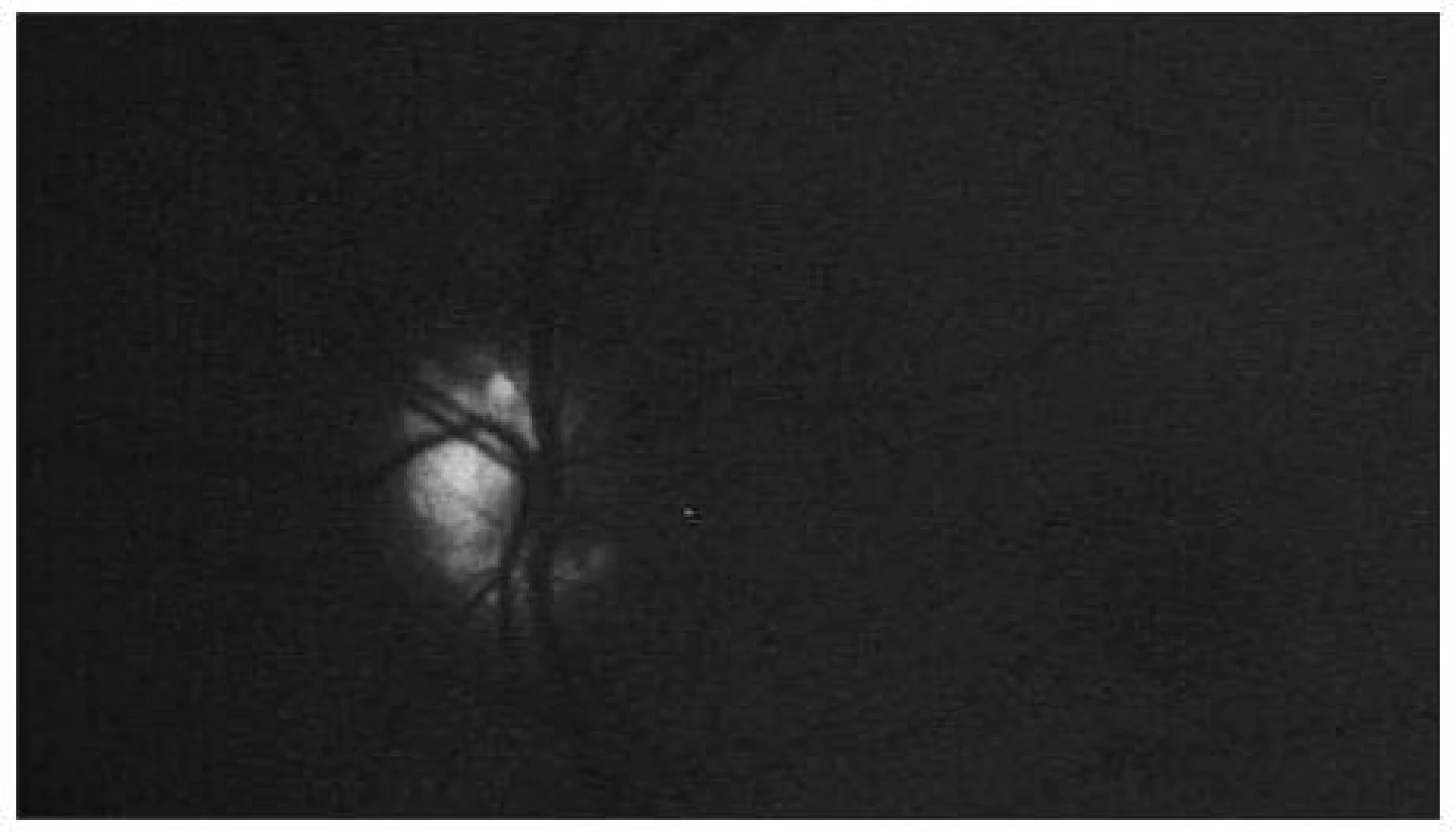 Autofluorescencia drúz zrakového nervu – ľavé oko