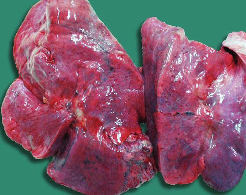 Tardieuovy skvrny pod poplicnicemi obou plic u zardoušení. Predilekční výskyt v mezilalokových rýhách obou plic pod poplicnicemi.
