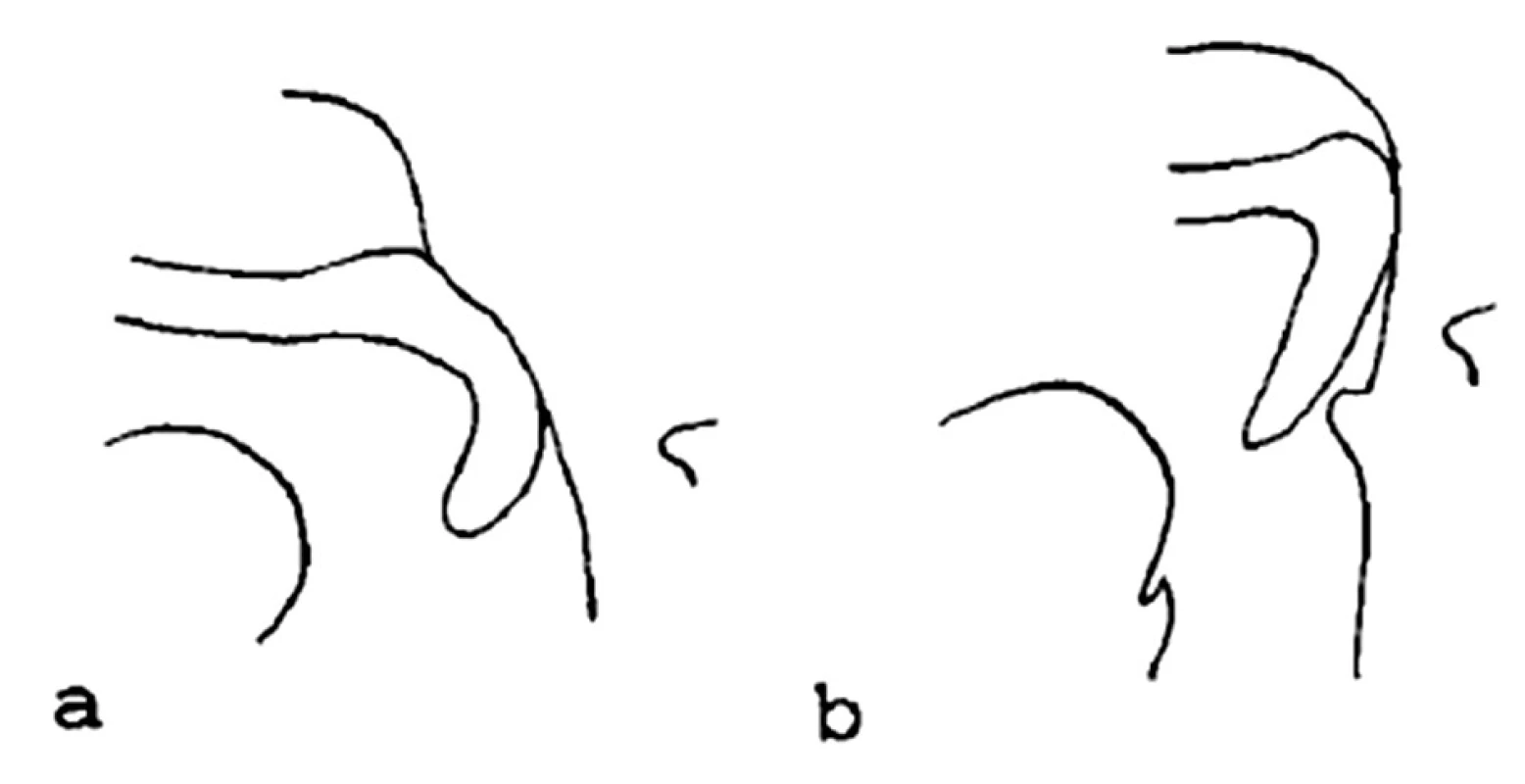 Schéma velofaryngeálního uzávěru bez přítomnosti Passavantova valu (a) a s ním (b). Převzato od Isberg, 1990 (7).