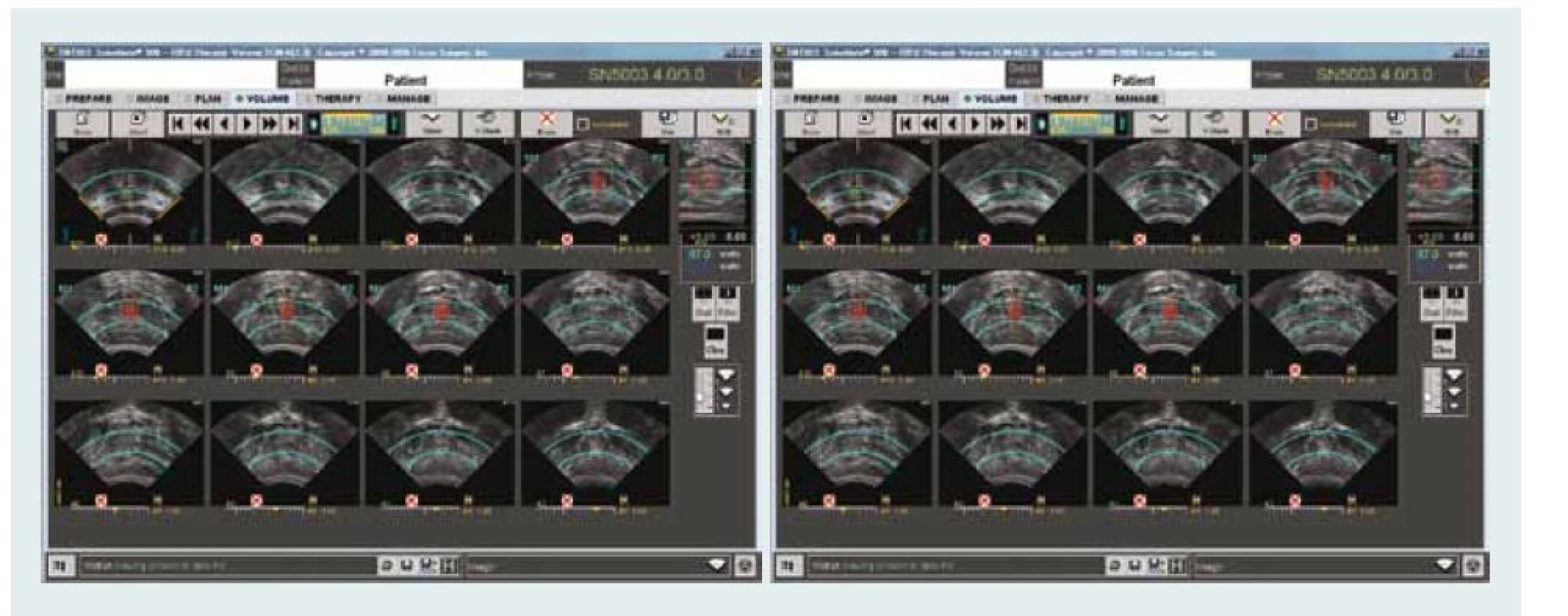 HIFU – kontrolní obrazovka ukazuje příčný řez prostatické žlázy (levá obrazovka) a sagitální řez (pravá obrazovka) s barevně označenou oblastí ablace. 