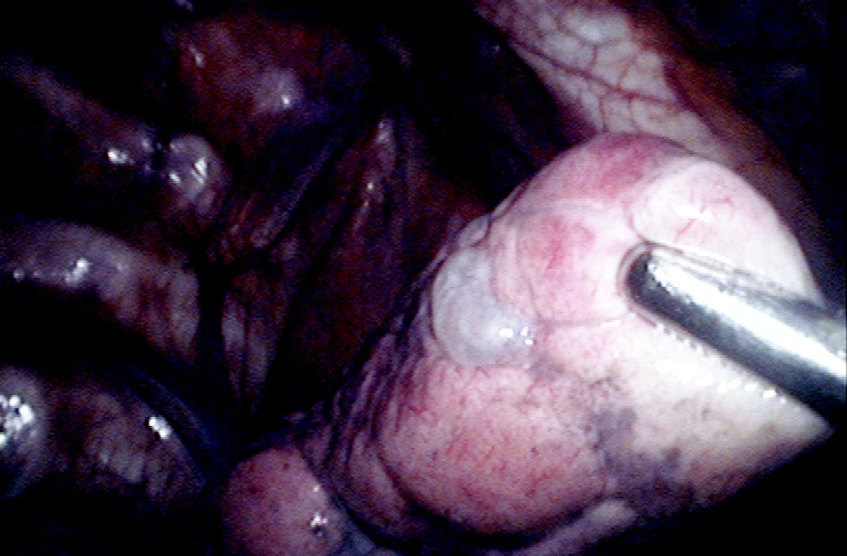 Subpleurální puchýř na apexu pravé plíce (operační foto)
Fig. 2. A subpleural bleb (blister) at the right pulmonary apex (intraoperative photo) 
