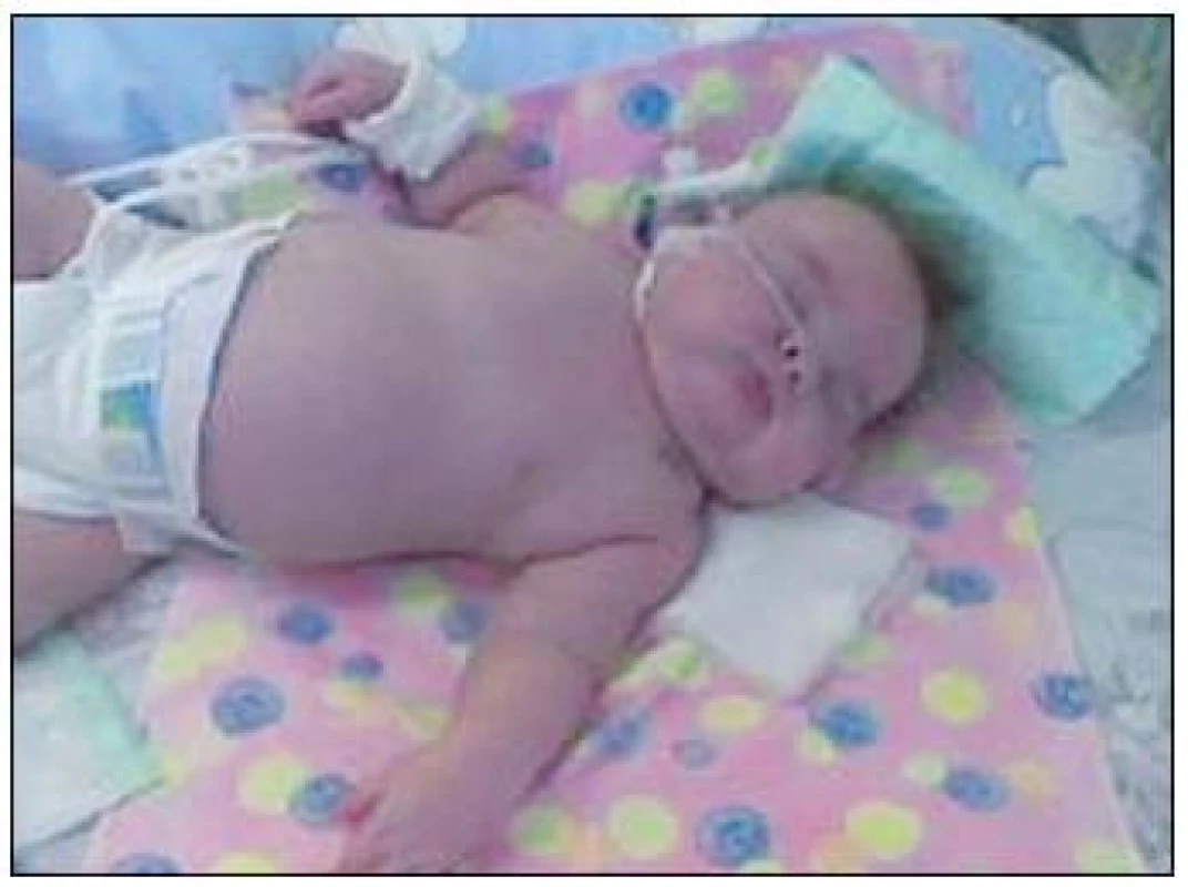 Typický vzhľad novorodenca s CHI (fotoarchív autorky).