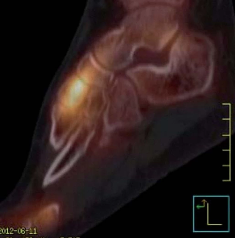 Dynamická scintigrafie (SPECT) (červen roku 2012). Vyšší perfuze i metabolický obrat v oblasti Lisfrankova skloubení včetně bází I. a II. metatarzu. Nález odpovídá MRI obrazu (obr. 3).