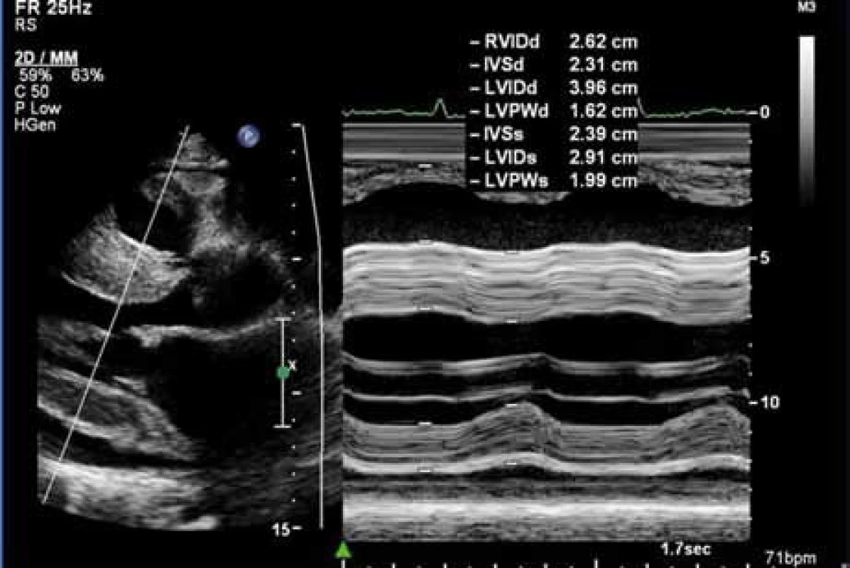 Echokardiografické zobrazení srdce. Hypertrofie myokardu stěn levé komory a interventrikulárního septa při srdeční amyloidóze, obraz zrnitého myokardu – „granular sparkling“, B a M obraz v projekci PLAX (dlouhá parasternální osa), IVSd = 23,1 mm (šíře interventrikulárního septa v diastole). Poskytnuto MUDr. R. Metelkou, Ph.D., III. interní klinika LF UP a FN Olomouc.