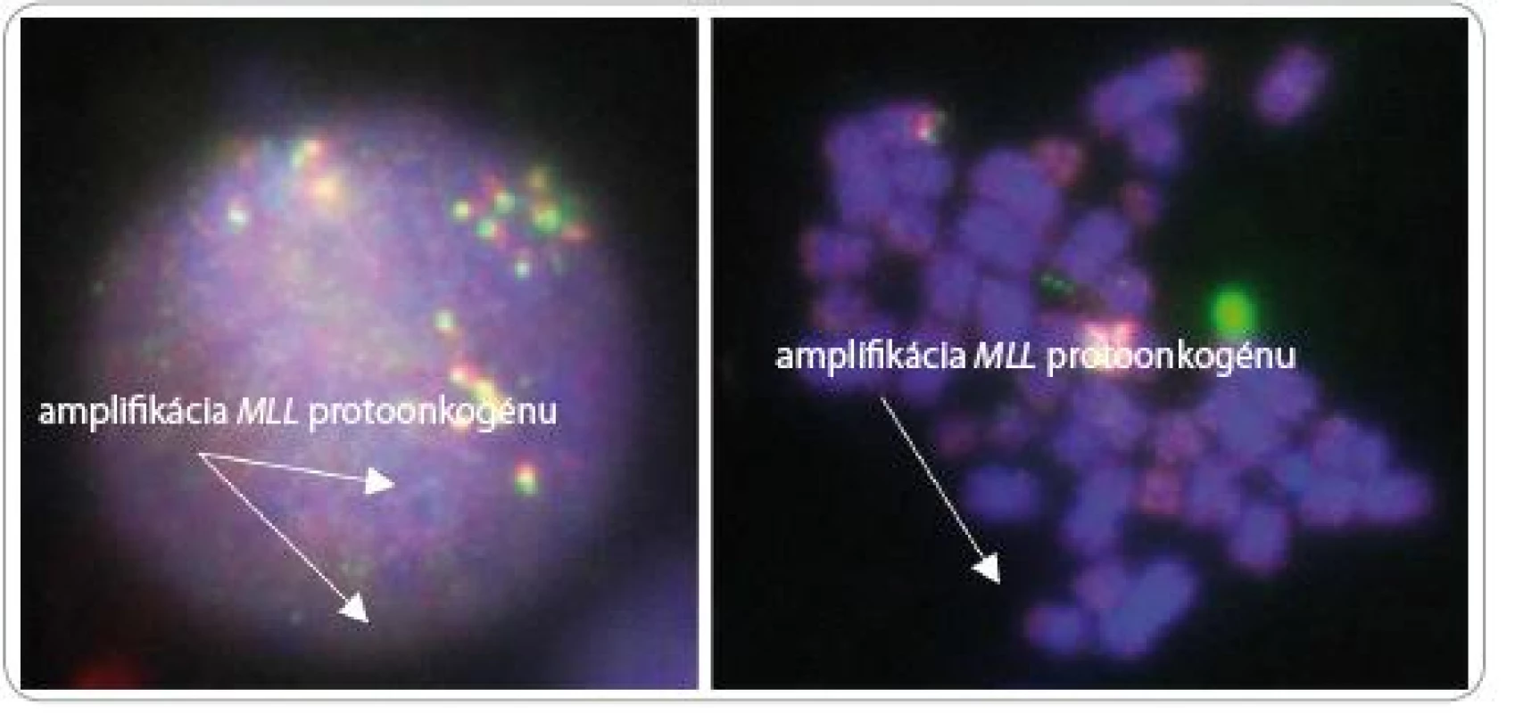 Výsledok fluorescenčnej analýzy získaný CCD kamerou. Vľavo interfázne jadro, vpravo mitóza. Amplifikácia MLL (9 kópií) u pacienta s karyotypom 44, XY, -5, hsr(11)(q23), -18, +21, +mar (C).