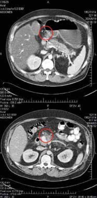 CT brucha s obrazom embolizovanej pseudoaneruryzmy a. gastroduodenalis (červený kruh)