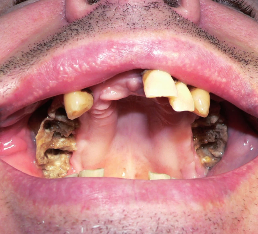 Rozsáhlá oboustranná osteonekróza horní čelisti s chronickými oroantrálními komunikacemi a oboustrannou chronickou maxilární rinosinusitidou (III. stadium) vzniklá po extrakcích zubů u pacienta s generalizovaným dobře diferencovaným konvenčním renálním karcinomem. Pacient byl mimo jiné léčen bisfosfonáty (2 měsíce zoledronát, 11 měsíců pamidronát) v konkomitanci s biologickou léčbou (12 měsíců sunitinib, 2 měsíce sorafenib).
Fig. 4. Extensive bilateral osteonecrosis of the maxilla with chronic oroantral communications and bilateral chronic maxillary rhinosinusitis (the 3rd stage) arised after teeth extraction in patient with metastatic well–diff erentiated convent ional renal cell carcinoma. The patient received bisphosphonates (zolendronate for 2 months, pamidronate for 11 months) and concomitant biological therapy (sunitinib for 12 months, sorafenib for 2 months) among other things.