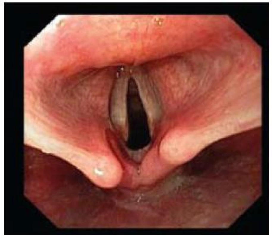 Mírná forma refluxní laryngitidy.
Fig. 11. Mild form of reflux laryngitis.