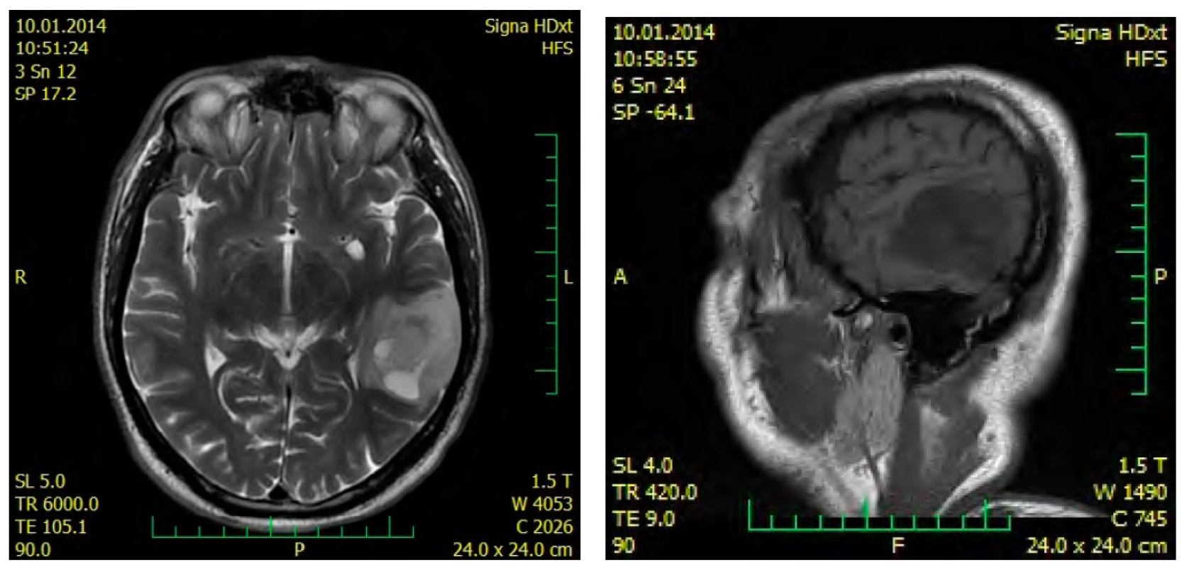MRI před resekcí tumoru v r. 2014