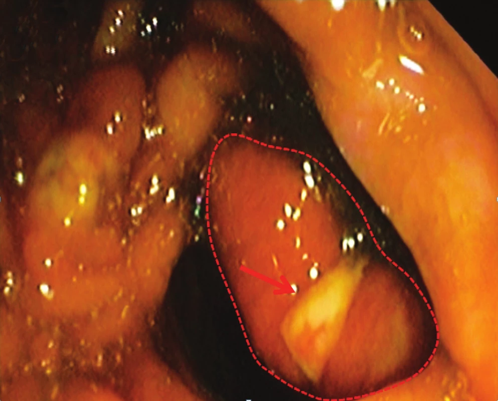 Endoskopický pohľad na slizničný mostík s léziou (červená šípka)
Fig. 1. Endoscopic view on tissue bridge with lesion (red arrow)