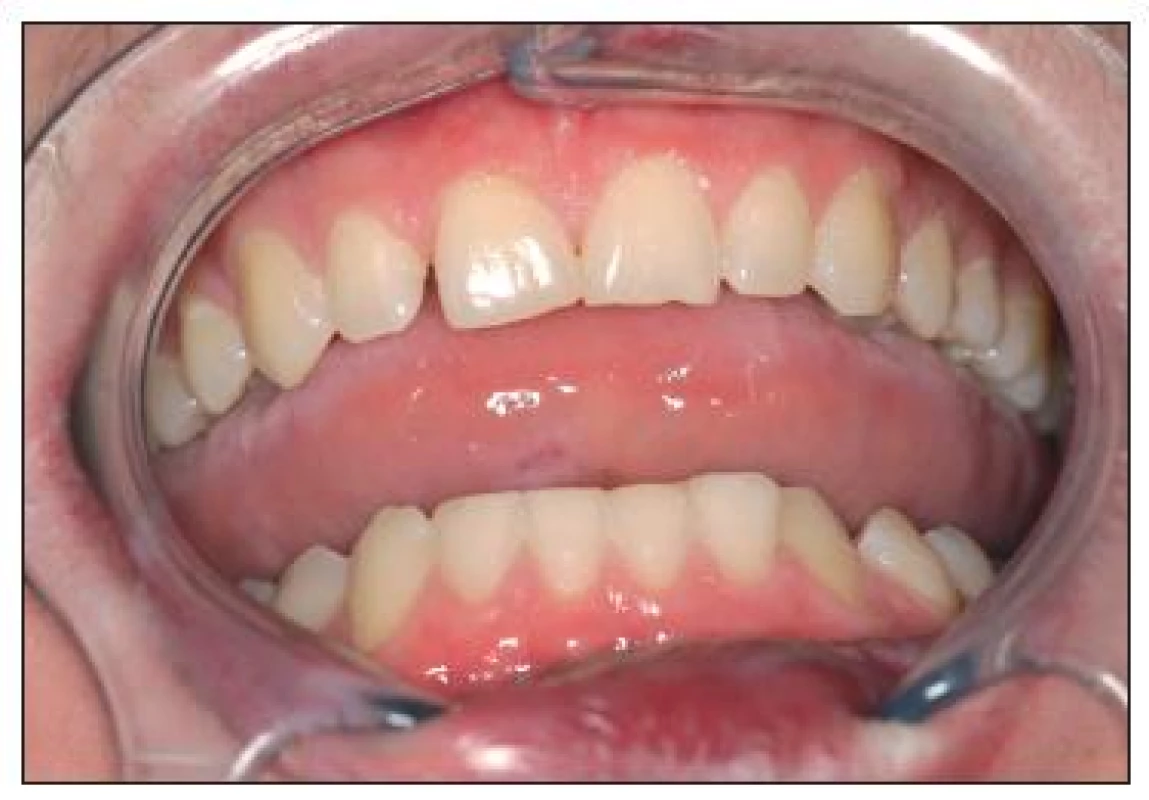 Po ukončení léčby dáseň a sliznice ústní dutiny bez zánětlivých změn.