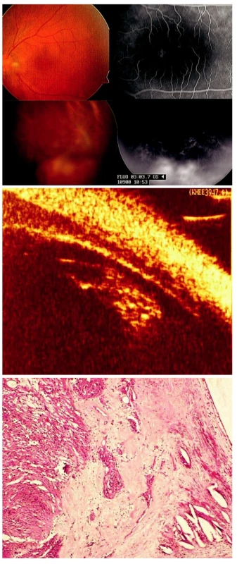 Coatsova nemoc manifestující se jako infekční chorioretinitida (toxokara, toxoplazma) u 37leté ženy. A) Cystoidní makulární edém a elevovaný žlutočervený útvar v periferii sítnice levého oka. Při fluorescenční angiografii patrné prosakování fluoresceinu v makule i elevovaném útvaru v periferii sítnice. B) Biomikroskopický ultrazvuk nepotvrdil zánětlivé změny. C) Histopatologické vyšetření enukleovaného pravého bulbu prokázalo exsudativní amoci, přítomnost cholesterolu a teleangiektatických cév s minimální zánětlivou reakcí