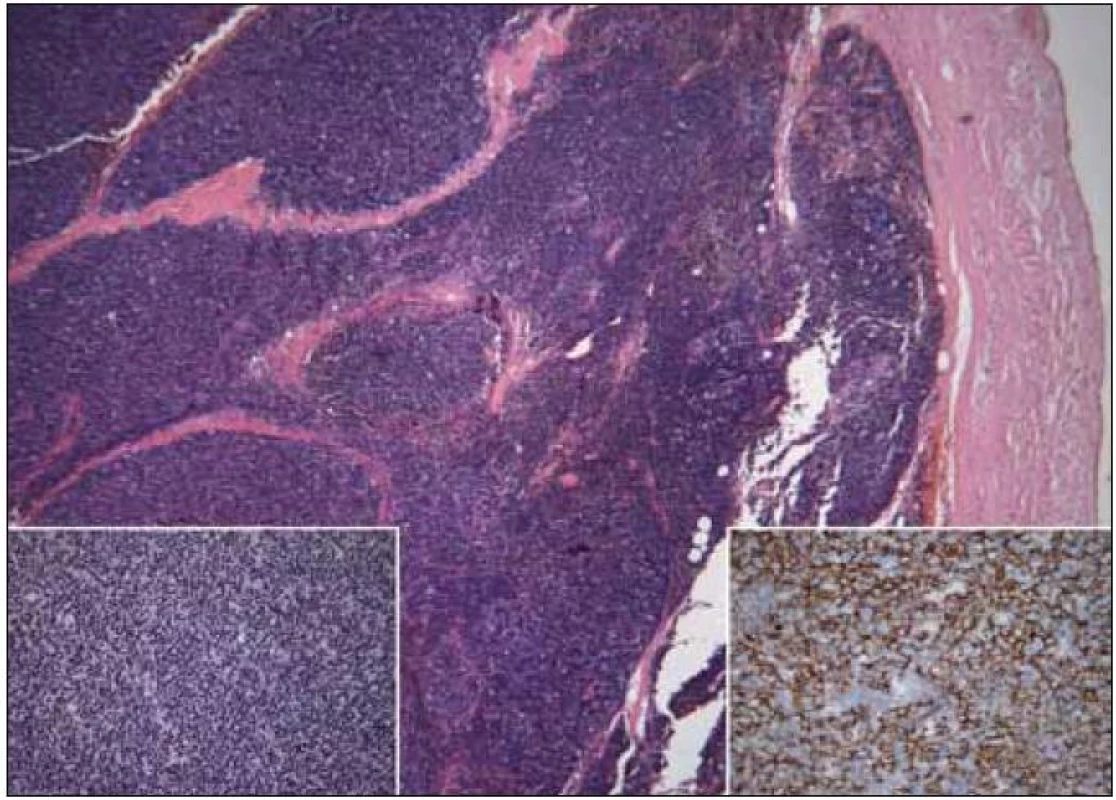 Thymom B1, vlevo dole detail struktury, vpravo dole imunohistochemický průkaz cytokeratinů směsi ukazující epiteliální nádorovou složku (kazuistika 2).