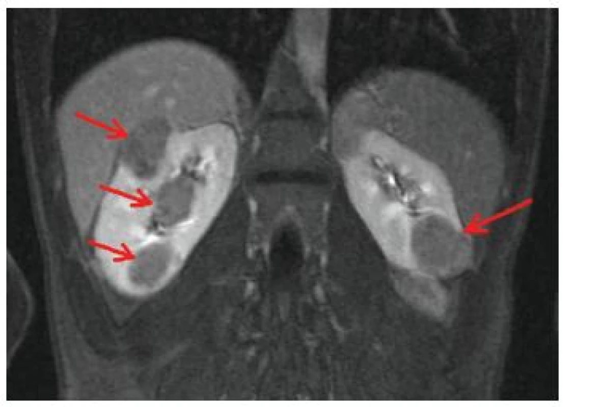 Vícečetné angiomyolipomy ledvin oboustranně (šipky) na MR vyšetření břicha v T2 vážených obrazech u 22letého muže