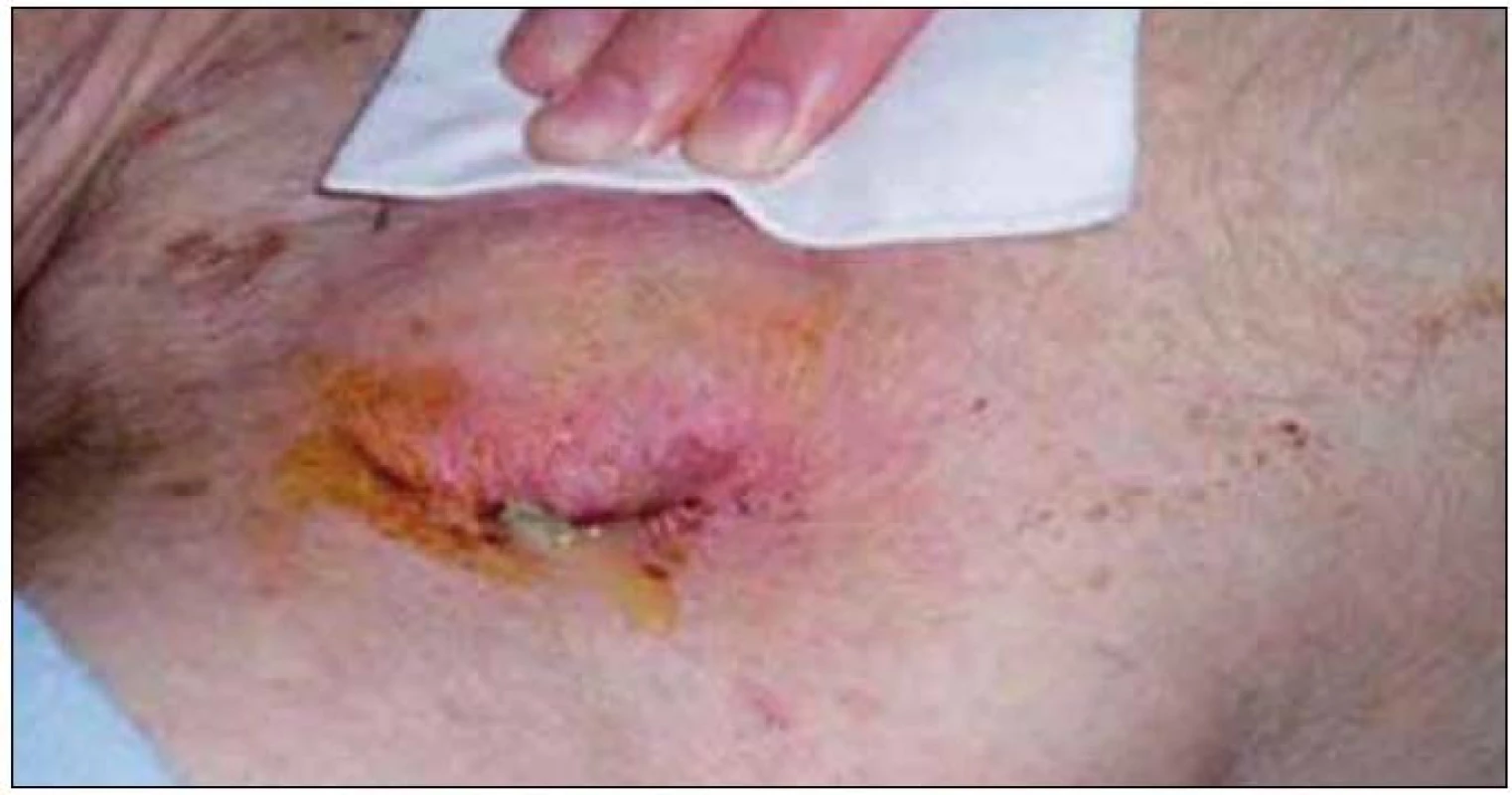 Infekcia kapsy ICD s erytémom, dehiscenciou a hnisavou secernáciou.
