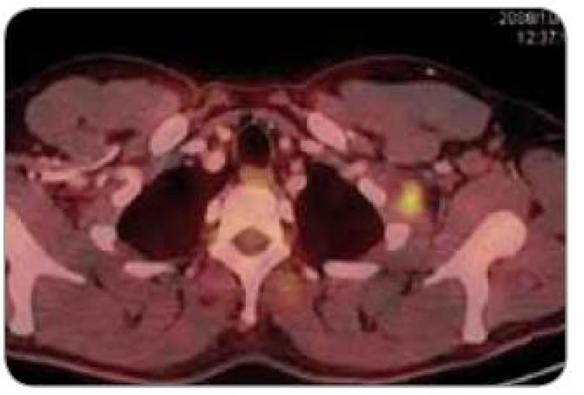 PET + CT – patologické ložisko v hrudní stěně vlevo.