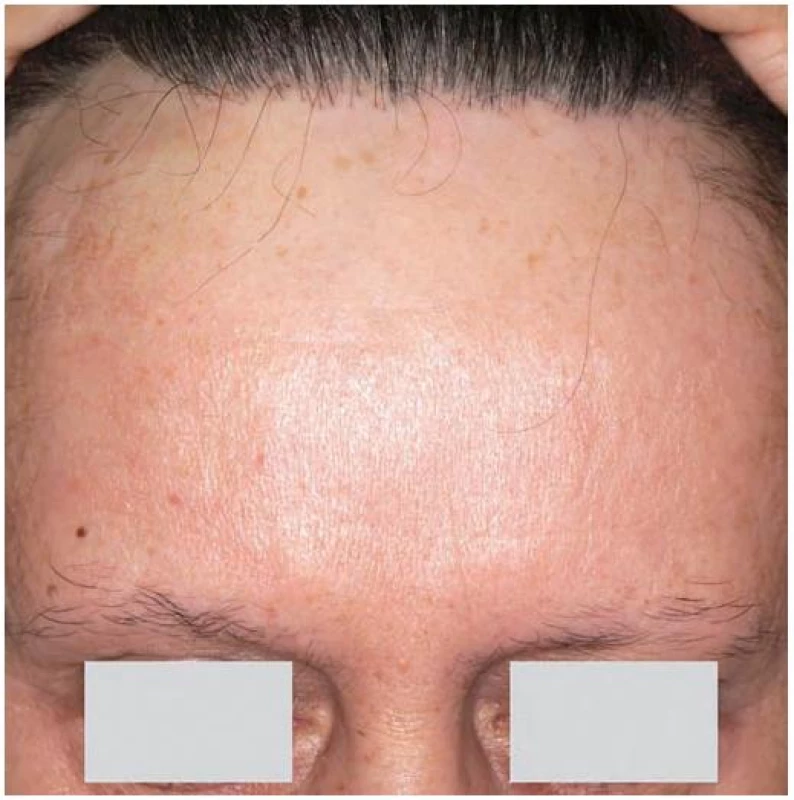 Frontální jizvící alopecie