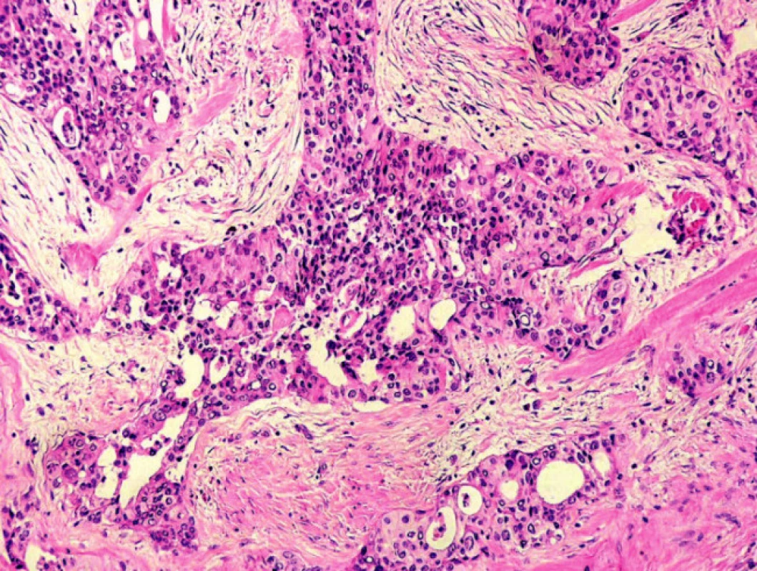 Histologický obraz metastázy karcinomu plic (HE, 100x).