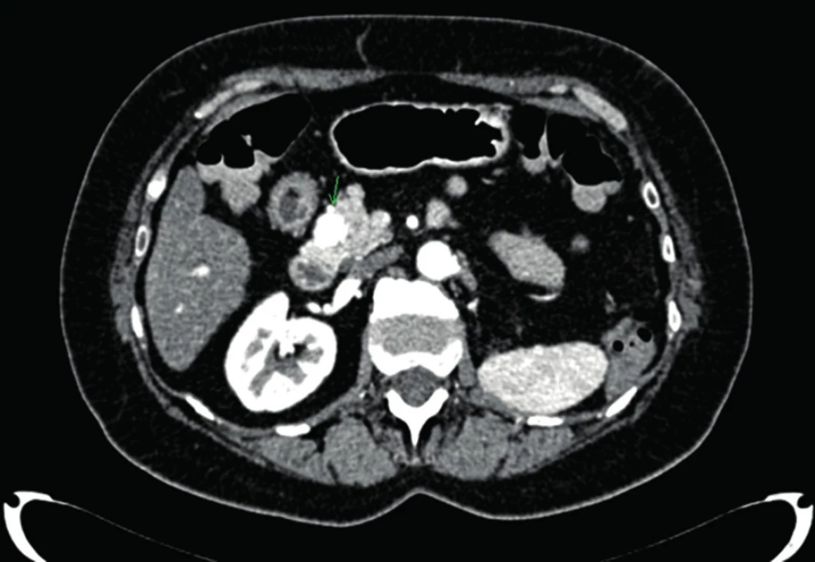 Metastáza v hlave pankreasu – CT
Fig. 1: Pancreatic head metastasis – CT