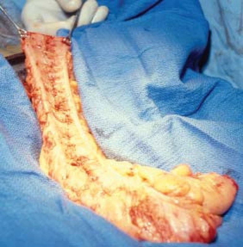 Na tomto operačním snímku je zachycen izolovaný segment ileocéka. Kolon bude otevřeno laterálně podél antimezenteriálního povrchu mezi dvěma teniemi.
