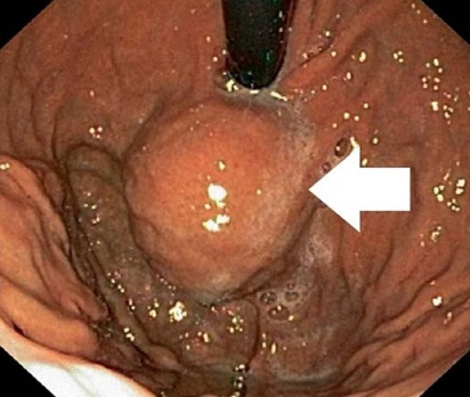 Gastroskopický nález v retroflexi přístroje, tumor označen šipkou.
Fig. 1. Gastroscopy finding in retroflection view, the tumour is marked with an arrow.