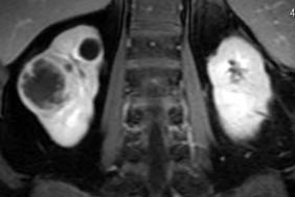 Cystoidní Grawitzův nádor pravé ledviny, srovnání zesílené stěny cystoidní expanze a prosté cysty v horním pólu téže ledviny.