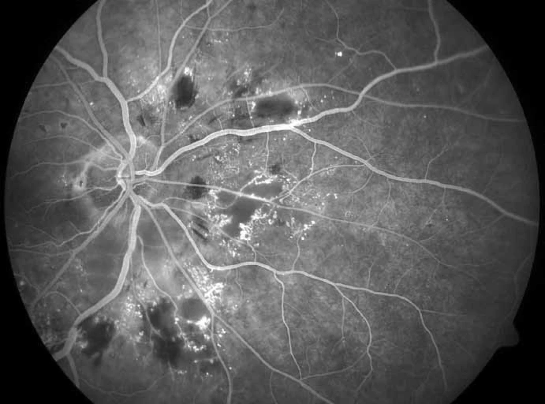 Fluorescenční angiografie pokročilé neproliferativní retinopatie zadního pólu a papily pravého oka, zobrazeny tmavé oblasti neprokrvené sítnice lemované dilatovanými kapilárami, četné hemoragie v hlubokých vrstvách sítnice a mnohočetná svítící mikroaneuryzmata.