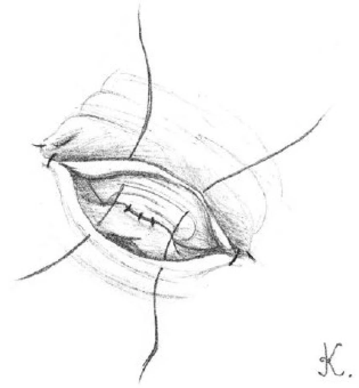 Přiblížení přední svalové vrstvy chámovodu s adventicií nadvarlete pomocí čtyř 9-0 nylonových stehů
Fig. 6. The approximation of the anterior muscle layers of vas deferens and the adventitial epididymal are approximated with four 9-0 nylon sutures