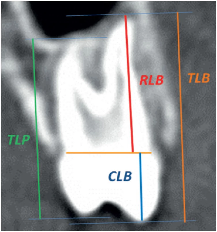 Měření na CBCT: TLB, TLP (tooth length buccal/palatal - délka zubu bukálně/palatinálně) – vzdálenost mezi apexem kořene a nejvyšším bodem bukálního nebo palatinálního hrbolku. RLB (root length buccal - délka kořene bukálně) - vzdálenost mezi apexem kořene a cemento-sklovinnou hranicí na bukální straně, CLB (crown length buccal - délka korunky bukálně) – vzdálenost mezi nejvyšším bodem bukálního hrbolku a cemento-sklovinnou hranicí na bukální straně.