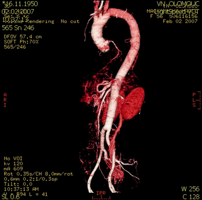 CT rekonstrukce pooperačního stavu hrudní a břišní aorty po náhradě cévní protézou
Fig. 4. A CT reconstruction of the postoperative condition of the thoracic and abdominal aorta following the vascular prosthesis implantation