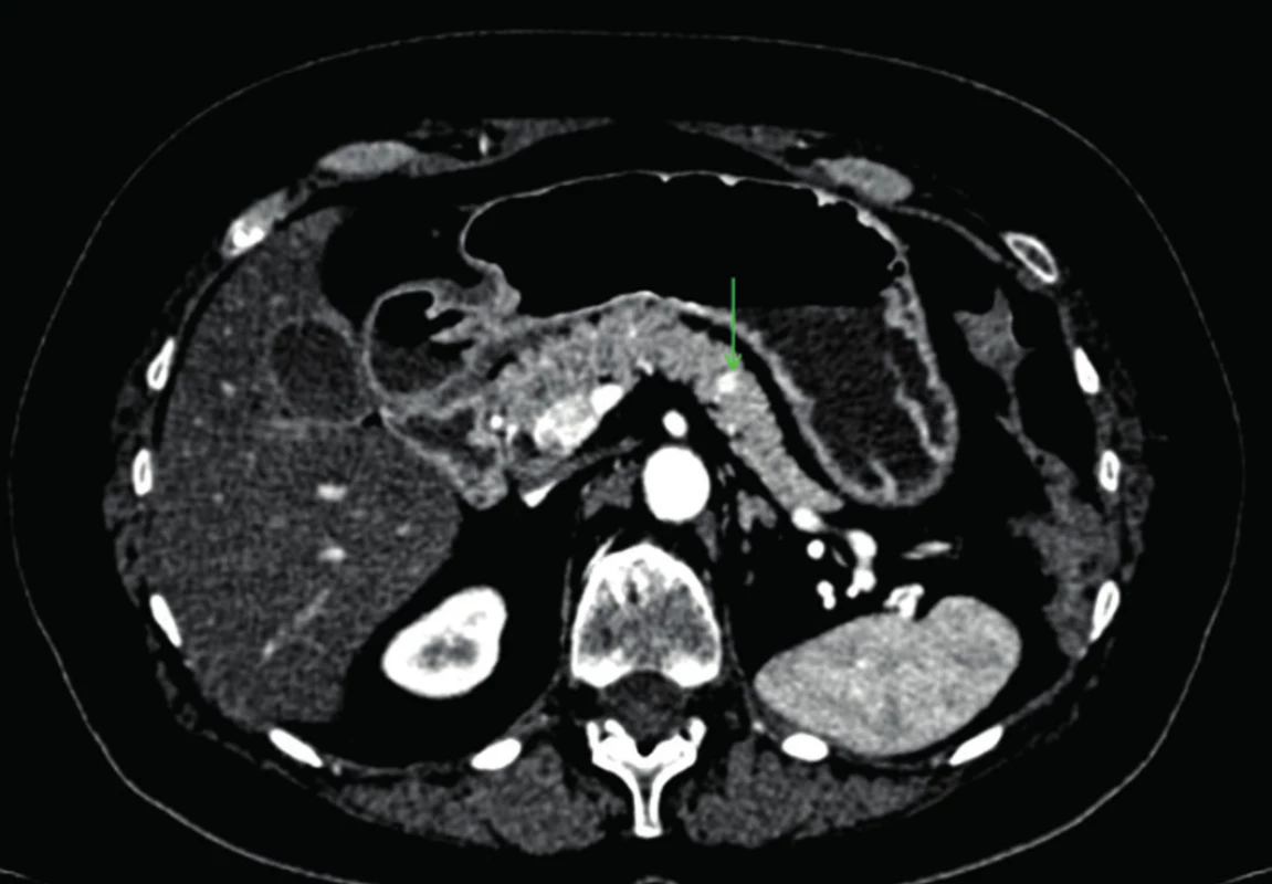Metastáza v chvoste pankreasu – CT
Fig. 2: Pancreatic tail metastasis – CT