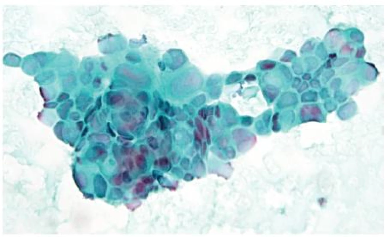 Cytologický obraz karcinomu pankreatu získaný FNA biopsií pod EUS kontrolou
Fragment středně diferencovaného duktálního adenokarcinomu, kompaktní formace nádorových buněk s výraznou anisocytózou, anisokaryózou, měnlivým, často zvýšeným nukleo-plazmovým poměrem a překrýváním jader. Nátěr barven polychromatickým barvením dle Papanicolaoua, zvětšení 400×.