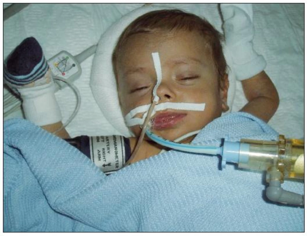 Dětský pacient krátce po transplantaci jater